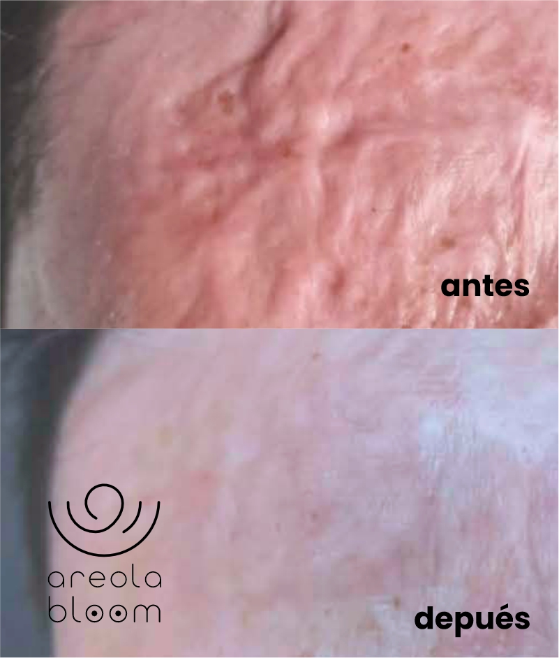 AREOLA BLOOM MICROPIGMENTACION AREROLAS