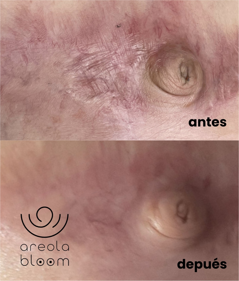 AREOLA BLOOM MICROPIGMENTACION AREROLAS