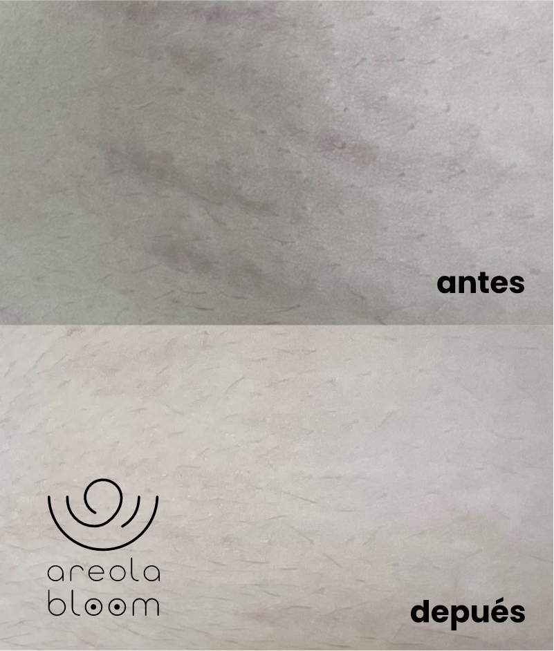 AREOLA BLOOM MICROPIGMENTACION AREROLAS